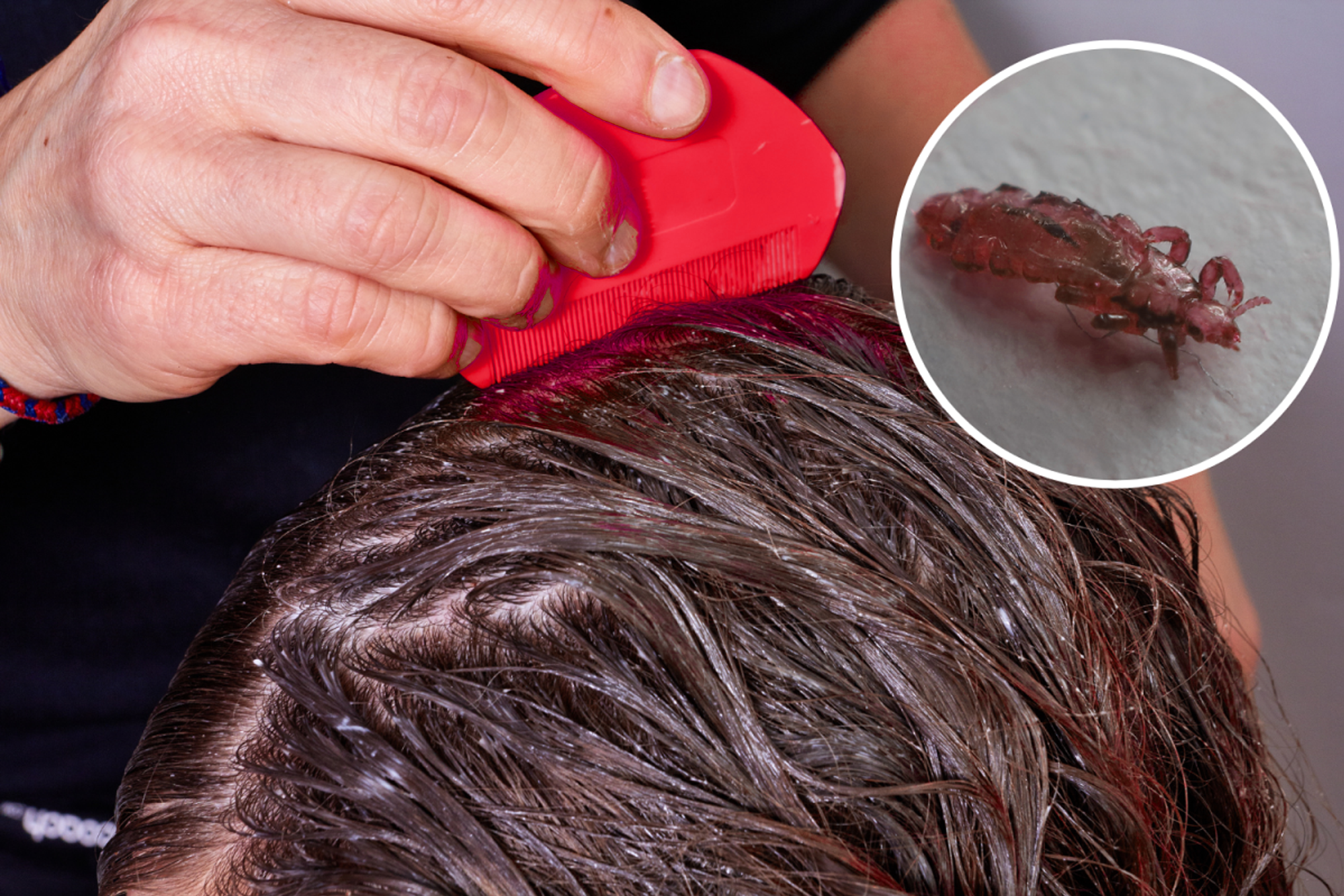 Do You Have Lice? How to Check and What to Do Next
